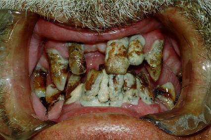 World's Ugliest Teeth