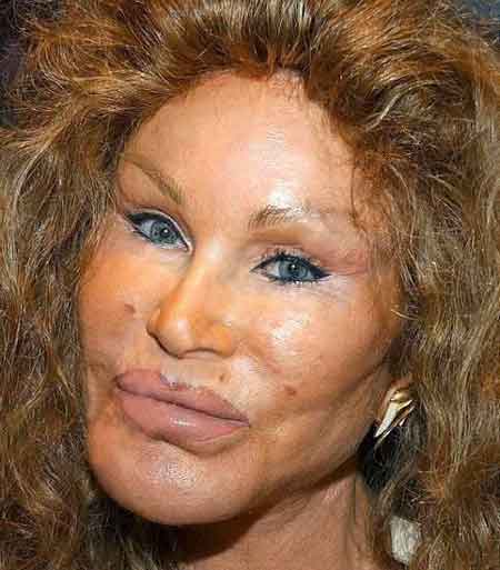 Worst Plastic Surgery